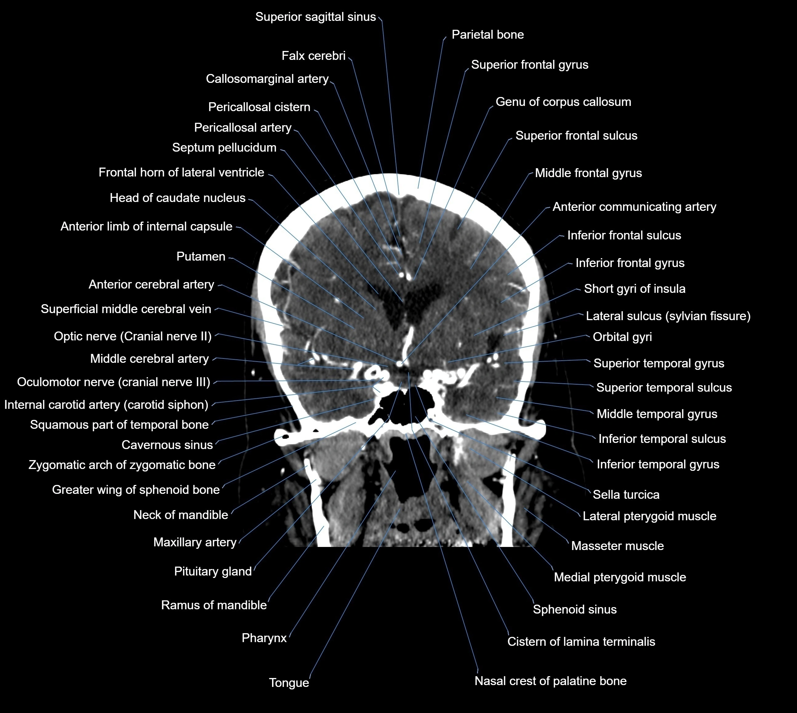 CT Brain coronal cross sectional radiology anatomy image  -img-00001-019.webp